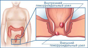 Узлы и шишки в заднем проходе (Чувство присутствия инородного тела) Узлы и шишки в заднем проходе (Чувство присутствия инородного тела)